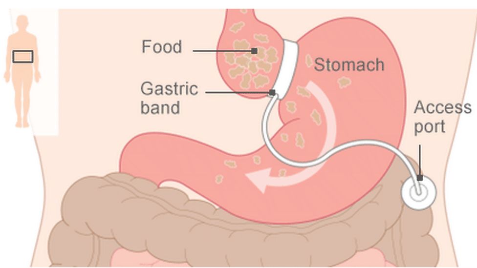 Gastric band