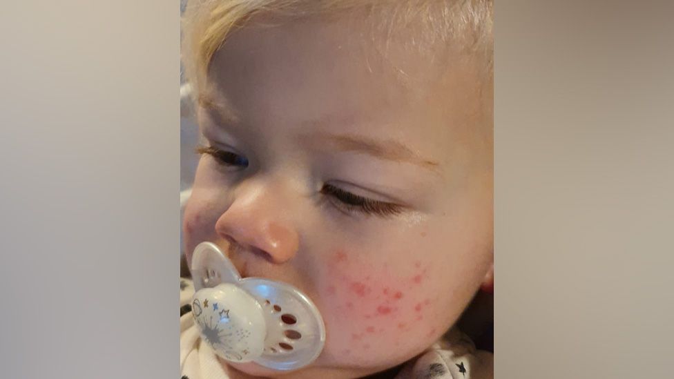 Do babies get a rash with covid