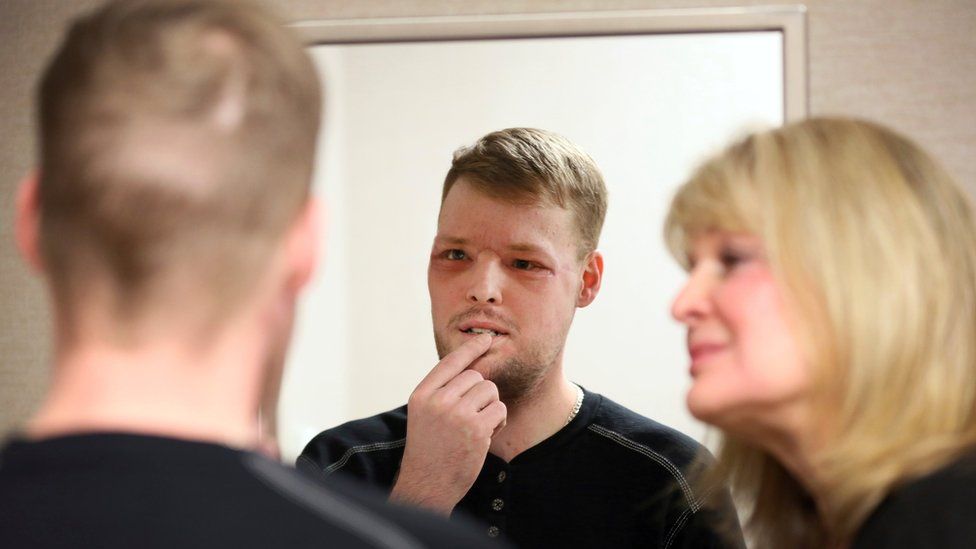 In this Jan. 24, 2017, photo, face transplant recipient Andy Sandness looks in a mirror during an appointment with physical therapist Helga Smars, right, at Mayo Clinic in Rochester, Minn