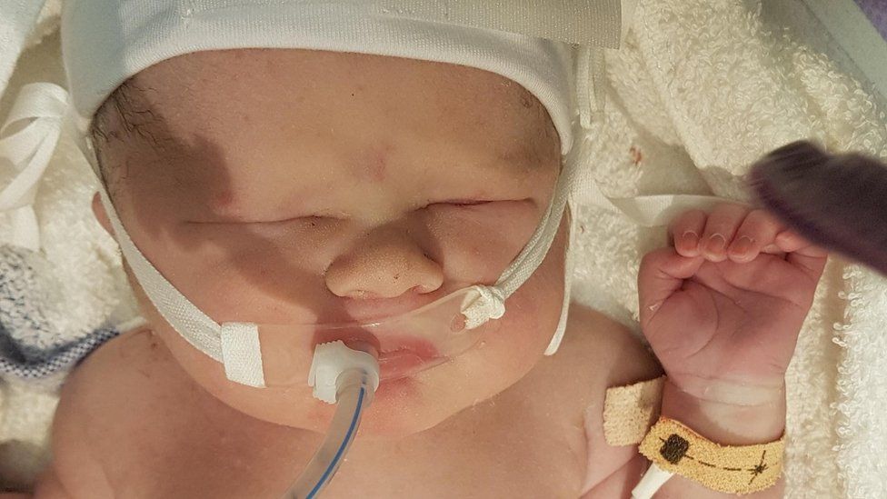 Baby with breathing tube inserted
