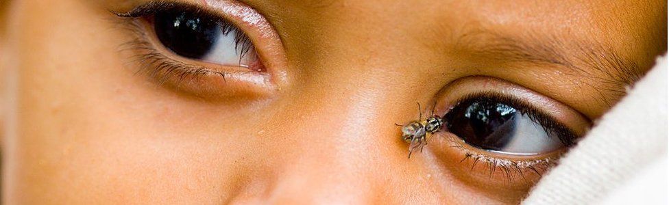 A female Musca Sorbens fly, the vector of trachoma, lands on a baby's eye in Ethiopia