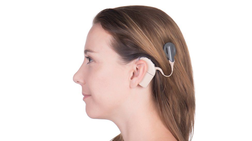 Young woman wearing a cochlear implant