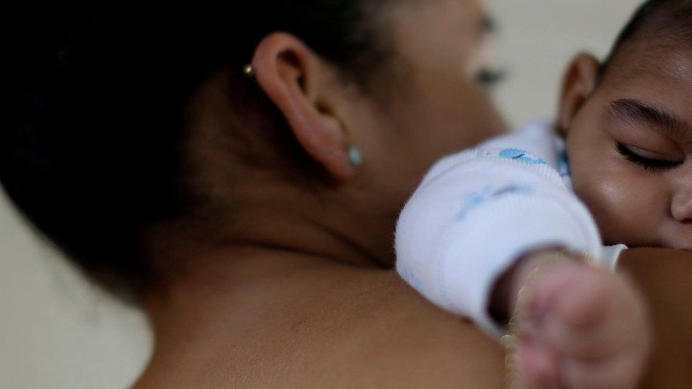 A mother holds her 4-month old baby born with microcephaly