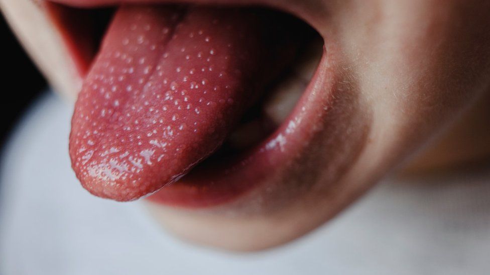 Child tongue with scarlet fever