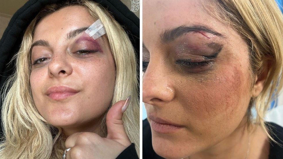 A composite image of Bebe Rexha - in the two selfies, you can see her right eye is bruised, and that there is a stitch in her eyebrow