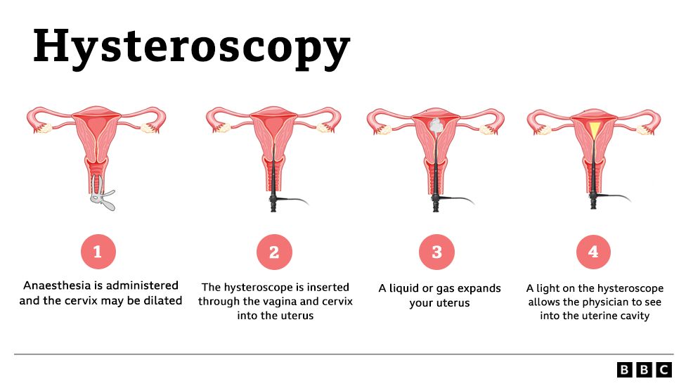 Infographic: What is a hysteroscopy?
