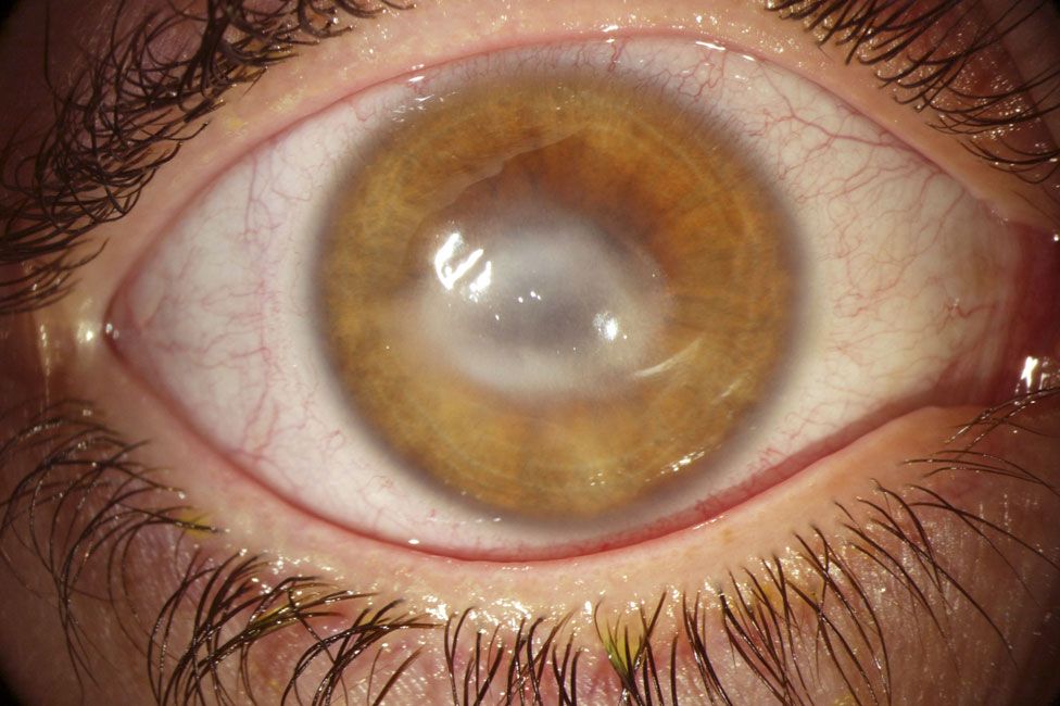 An eye affected by acanthamoeba keratitis