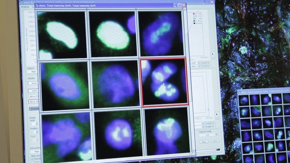 Cancer images on computer screen