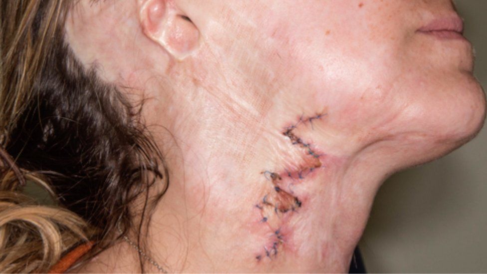 Adele's neck scar