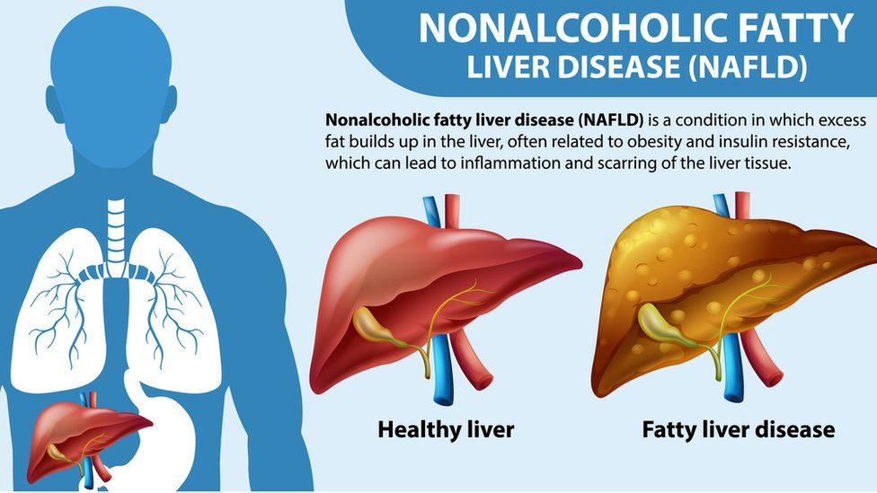 Diagram explaining the formation of fatty liver compared to a healthy liver