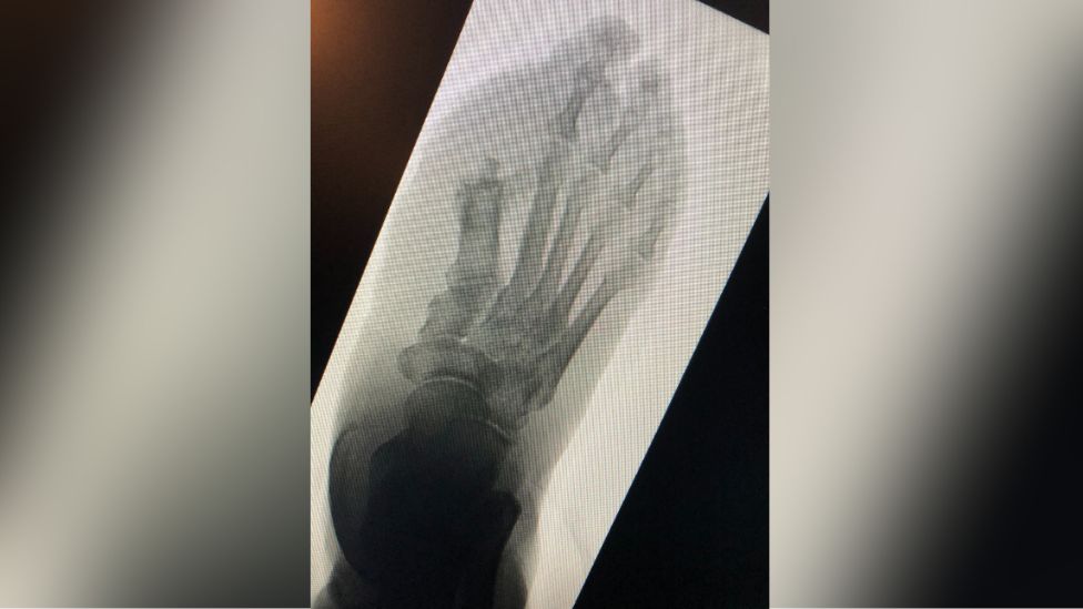 An x-ray of a foot 