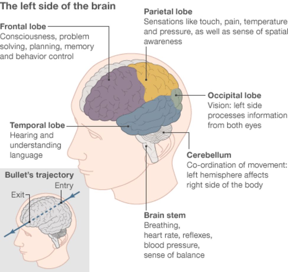 treating-a-gunshot-to-the-head-extreme-brain-surgery-bbc-news