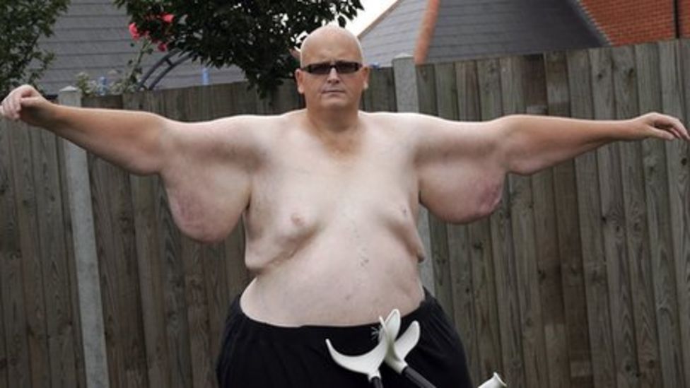'World's fattest man' Paul Mason faces US surgery delay - BBC News
