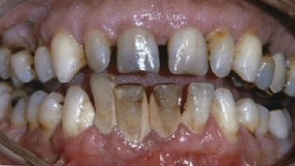 Belfast scientists say aspirin could reverse tooth decay BBC News