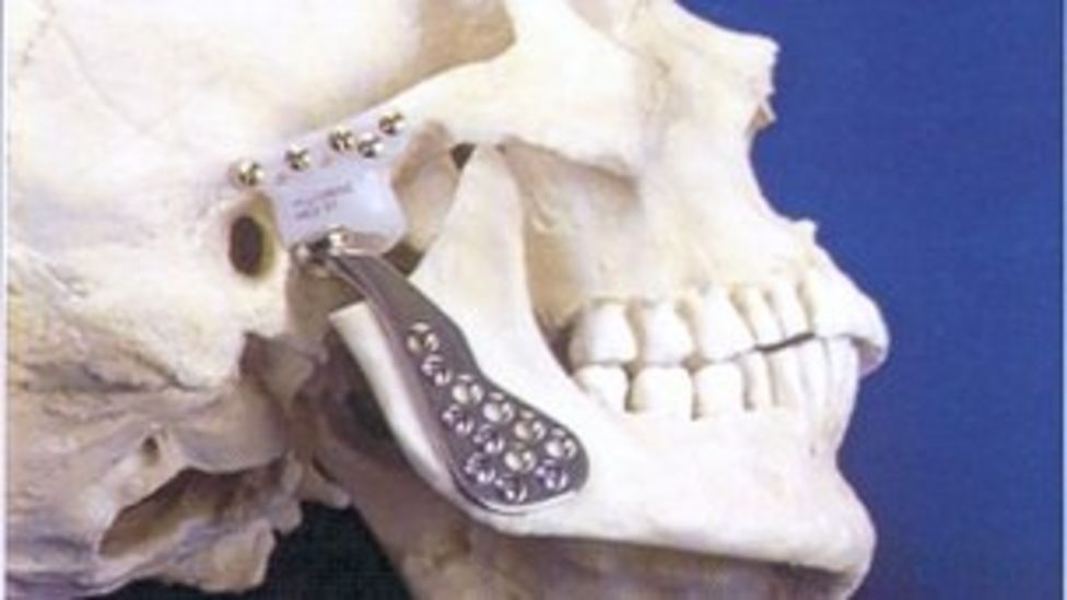 'Jaw replacement surgery ended my unbearable pain' BBC News