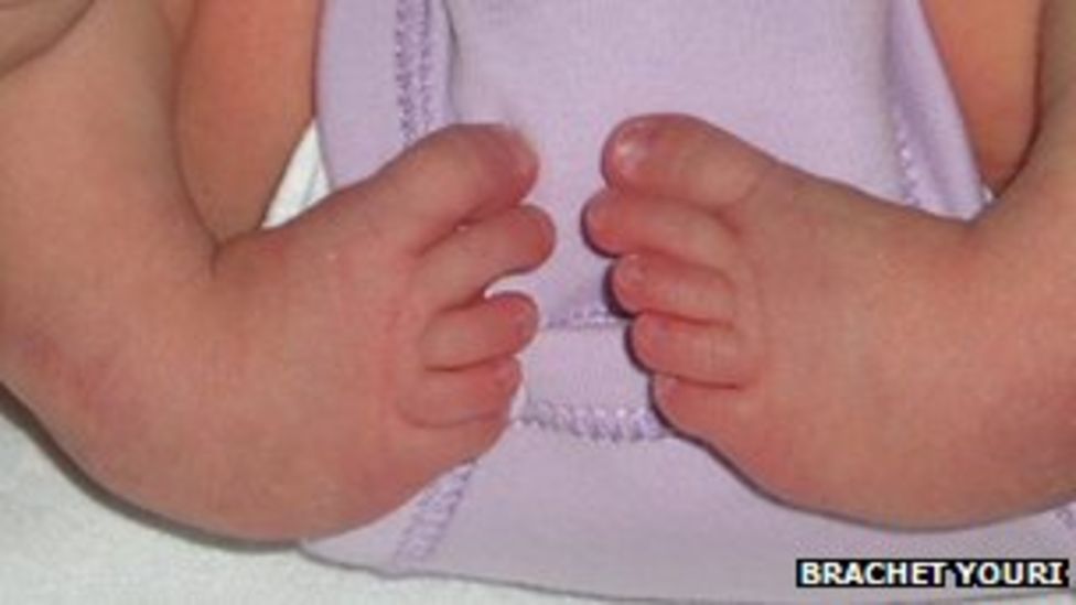 Pioneering clubfoot treatment celebrated at Royal Derby Hospital BBC News