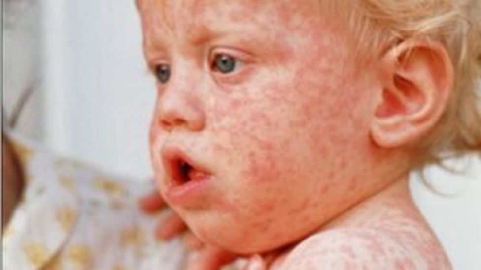 Measles cases 'almost double' after outbreaks BBC News