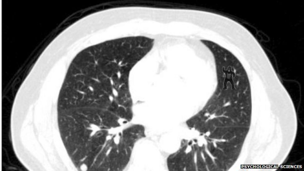 Why do radiologists miss dancing gorillas? BBC News
