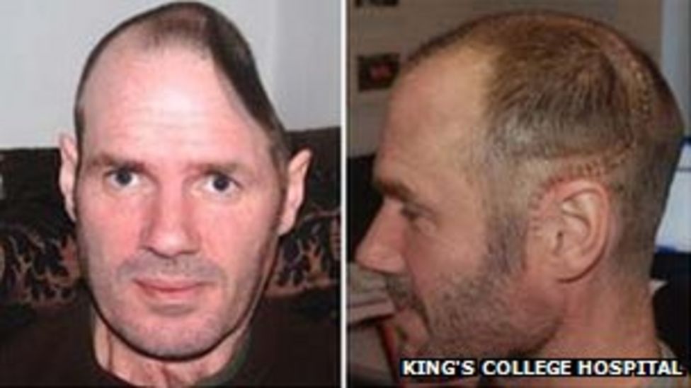 Skull rebuilt after King's College Hospital brain surgery BBC News
