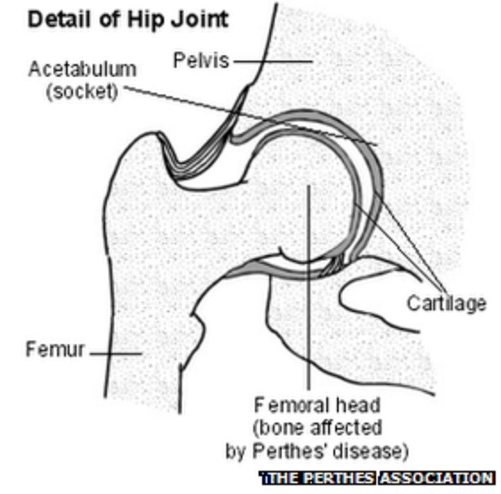 Modelling hip joint disease using 3D engineering tool - BBC News