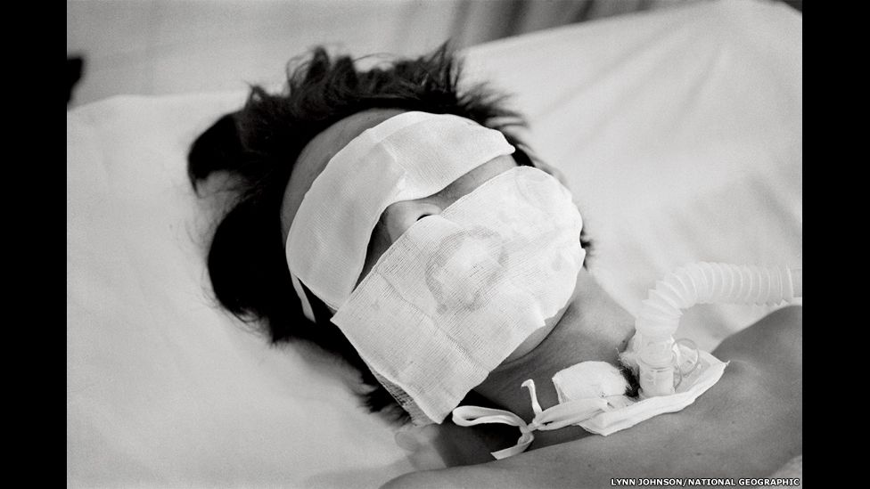 Comatose and on a ventilator, a bird flu patient in Hanoi who was not expected to live made a remarkable recovery.