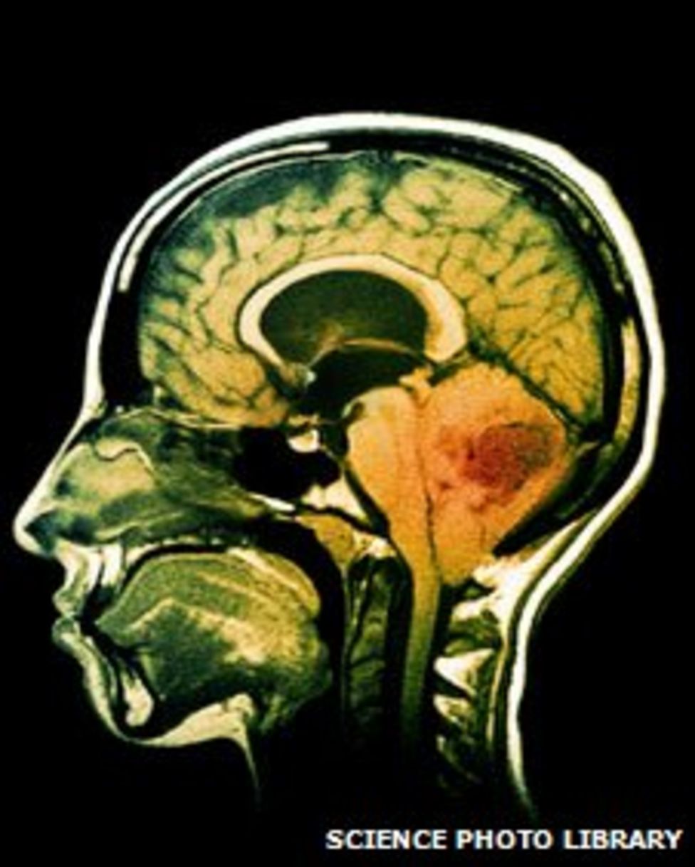 Early brain cancer diagnosis hopes pinned on blood test BBC News