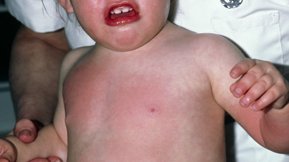 Hair straighteners pose child burn risk BBC News