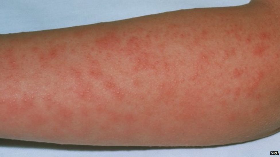 Scarlet fever cases hit 50year high in England BBC News