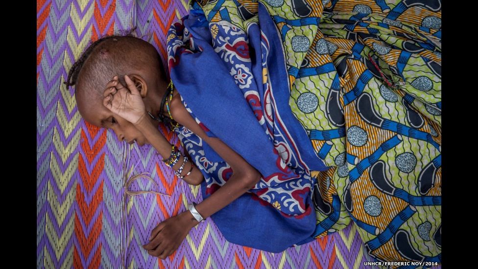 A malnourished CAR refugee child resting at the feeding centre in Batouri hospital in Cameroon.