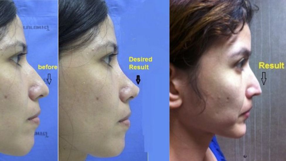 The dark side of cosmetic surgery in Thailand BBC News The dark side of cosmetic surgery in Thailand BBC News