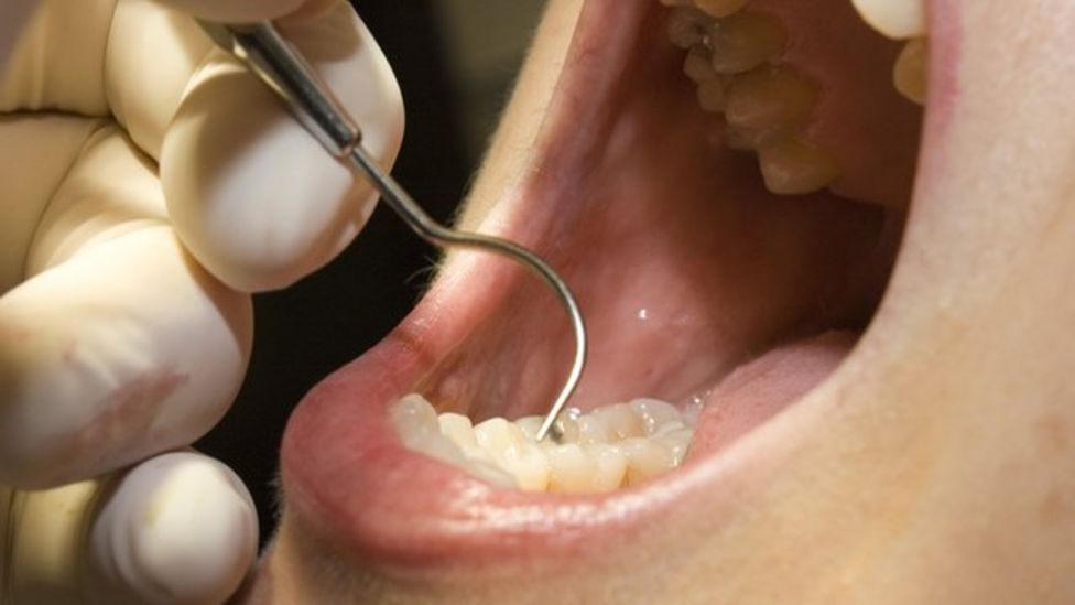 billions-have-untreated-tooth-decay-bbc-news