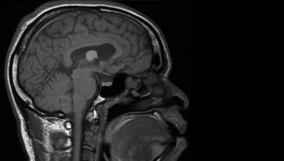 Scan of Matthew's brain injury