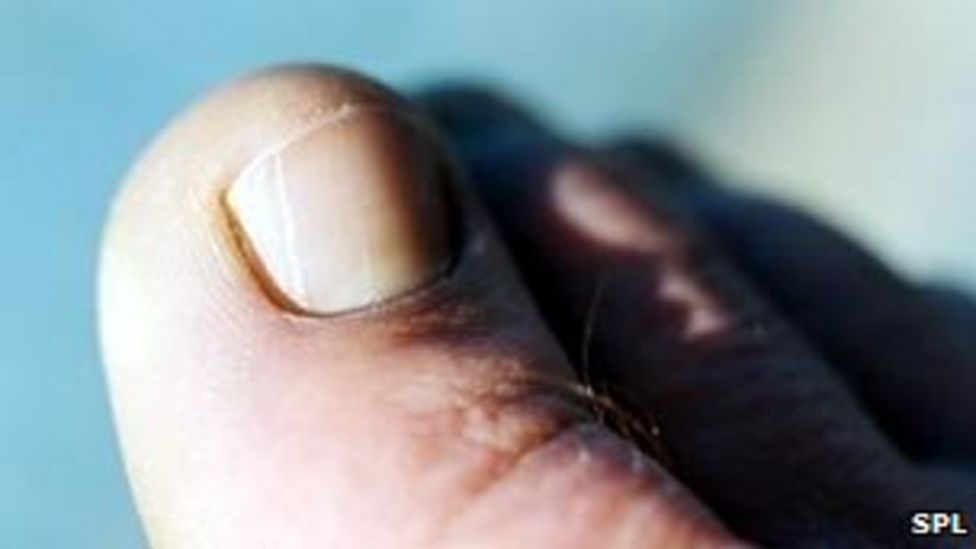 Toenails can reveal lung cancer risk BBC News