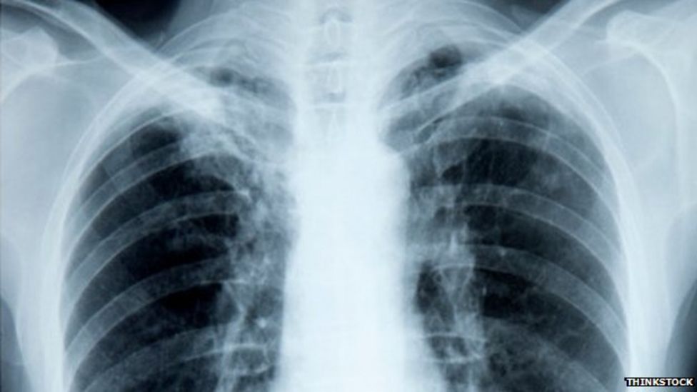 Early lung cancer diagnosis saved study test volunteer - BBC News
