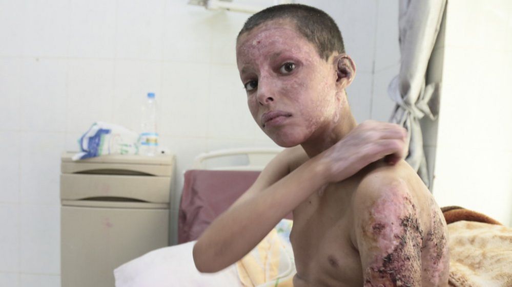 Abdallah Saleh, 15, at a hospital in Yemen (30 April 2015)