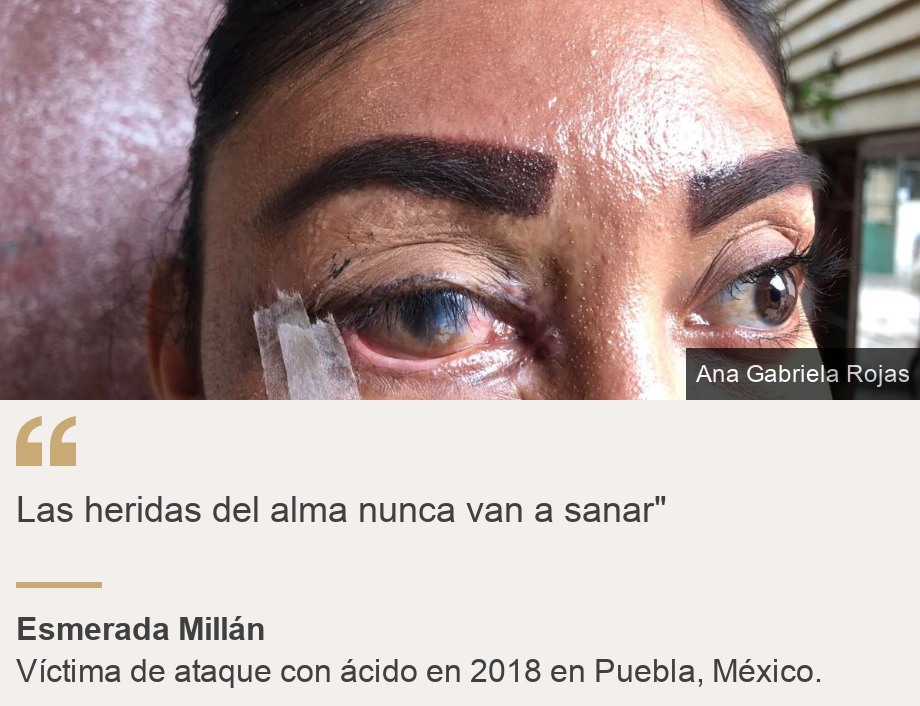 "Las heridas del alma nunca van a sanar"", Source: Esmerada Millán, Source description: Víctima de ataque con ácido en 2018 en Puebla, México. , Image: Primer pano de Esmeralda Millán. 