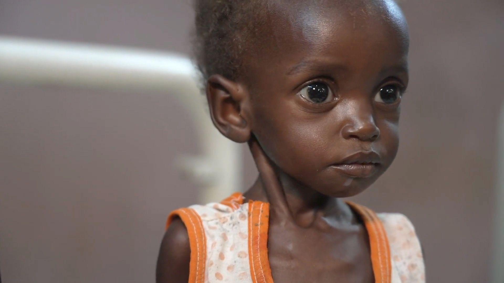 Inside a hospital on the front line of Sudan’s hunger crisis