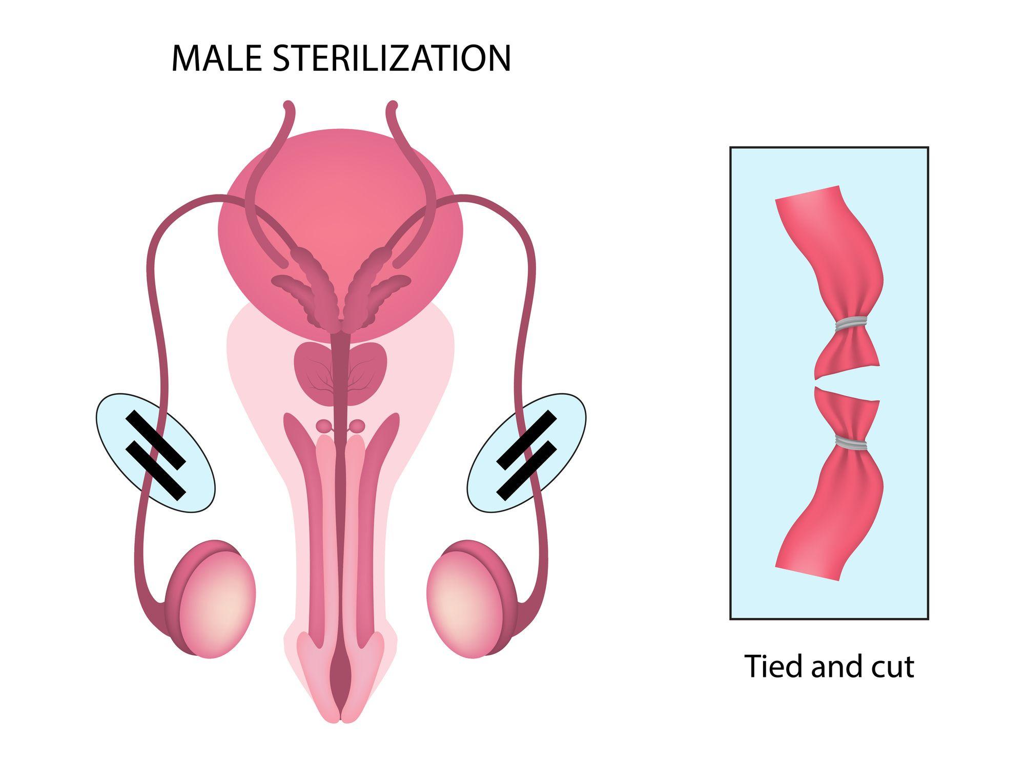 Vasektomi dilakukan dengan cara memotong atau mengikat saluran penyalur spermatozoa atau yang disebut sebagai vas deferens