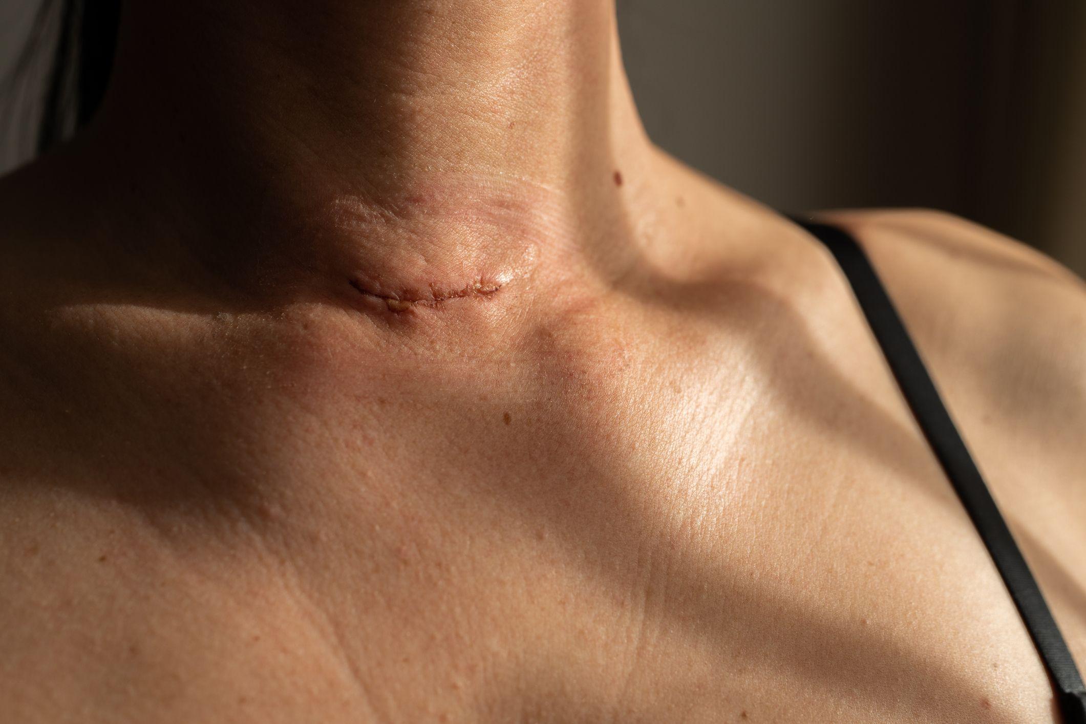 ندبة جراحية على رقبة امرأة بعد استئصال الغدة الدرقية.