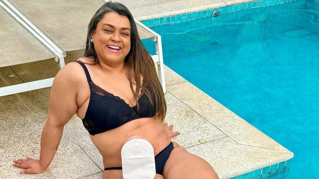 Preta Gil sorrindo à beira da piscina, com bolsa de colostomia no abdômen