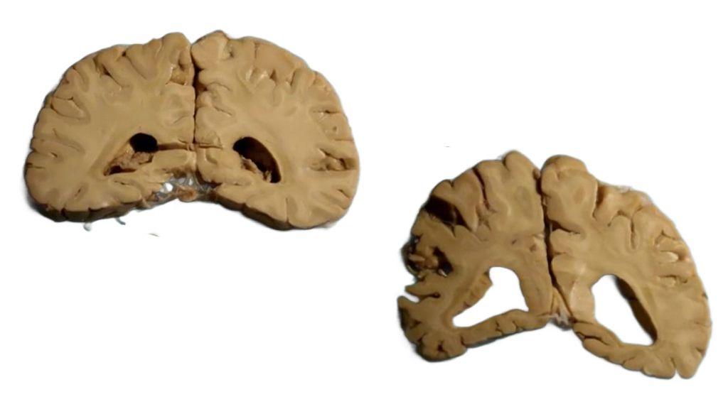 À esquerda, cérebro saudável de uma freira de 90 anos; à direita, cérebro de uma freira de 89 anos com Alzheimer