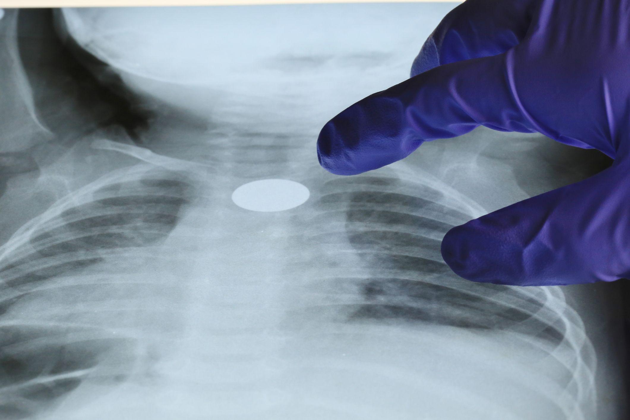 Una radiografía de un menor muestra un objeto redondo atascado en el tracto respiratorio