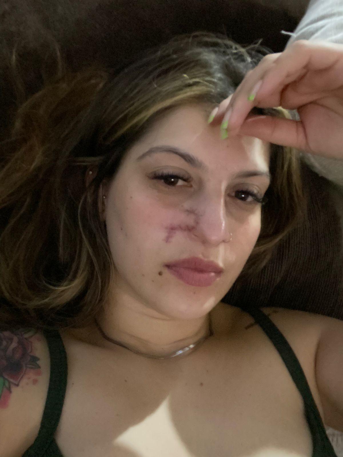 Daiane Lima com cicatriz durante a recuperação da cirurgia