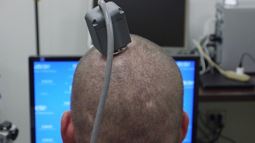 La cabeza de Ian Burkhart, de 23 años, muestra el puerto de su cabeza conectado a un chip en su cerebro durante una sesión de entrenamiento el 18 de junio de 2014.