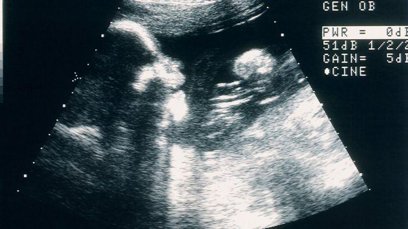 Imagem de uma ultrassonografia