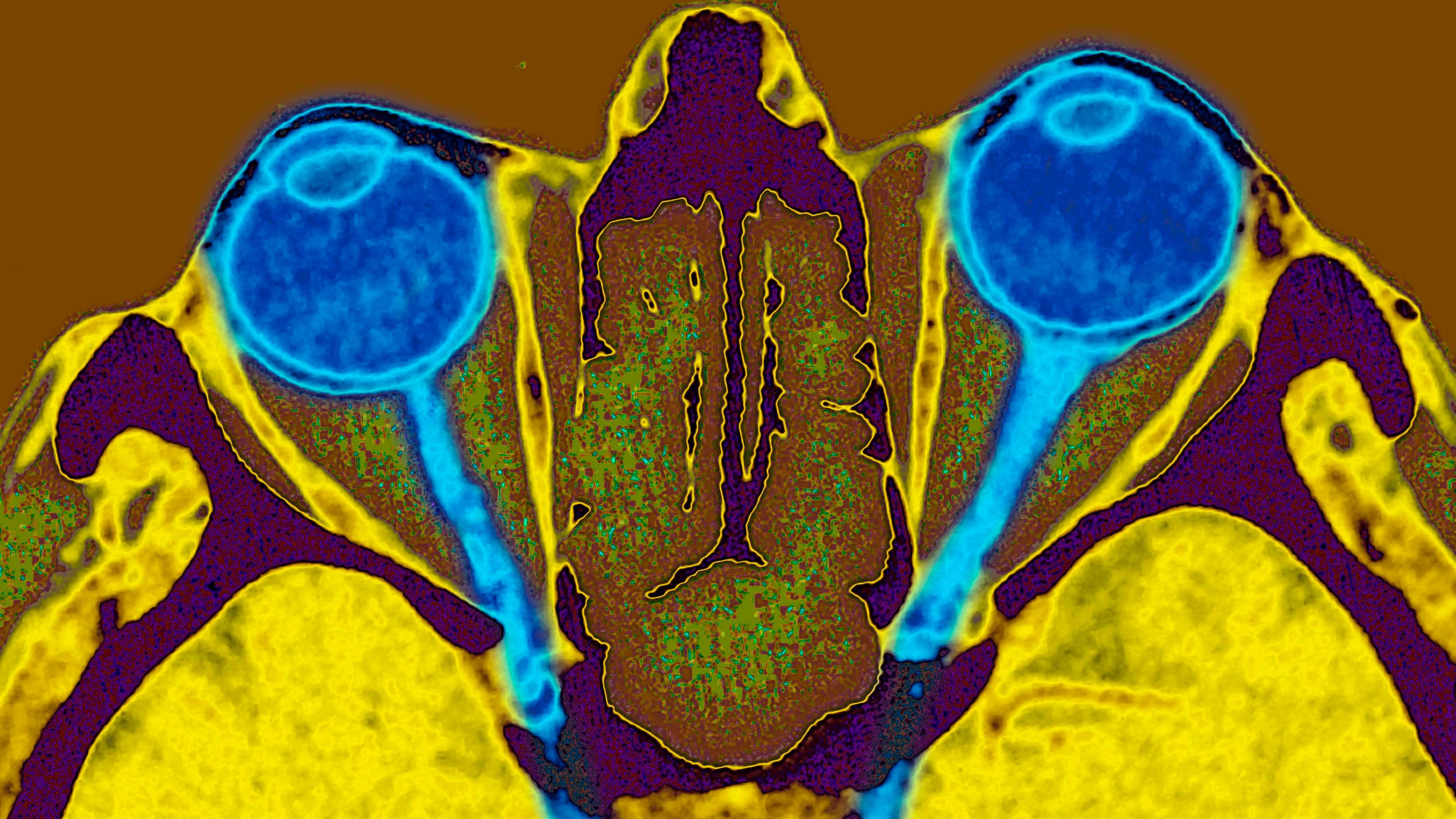 Two eyes and their optic nerves, seen on a radial section scan (photo byBSIP/Universal Images Group)