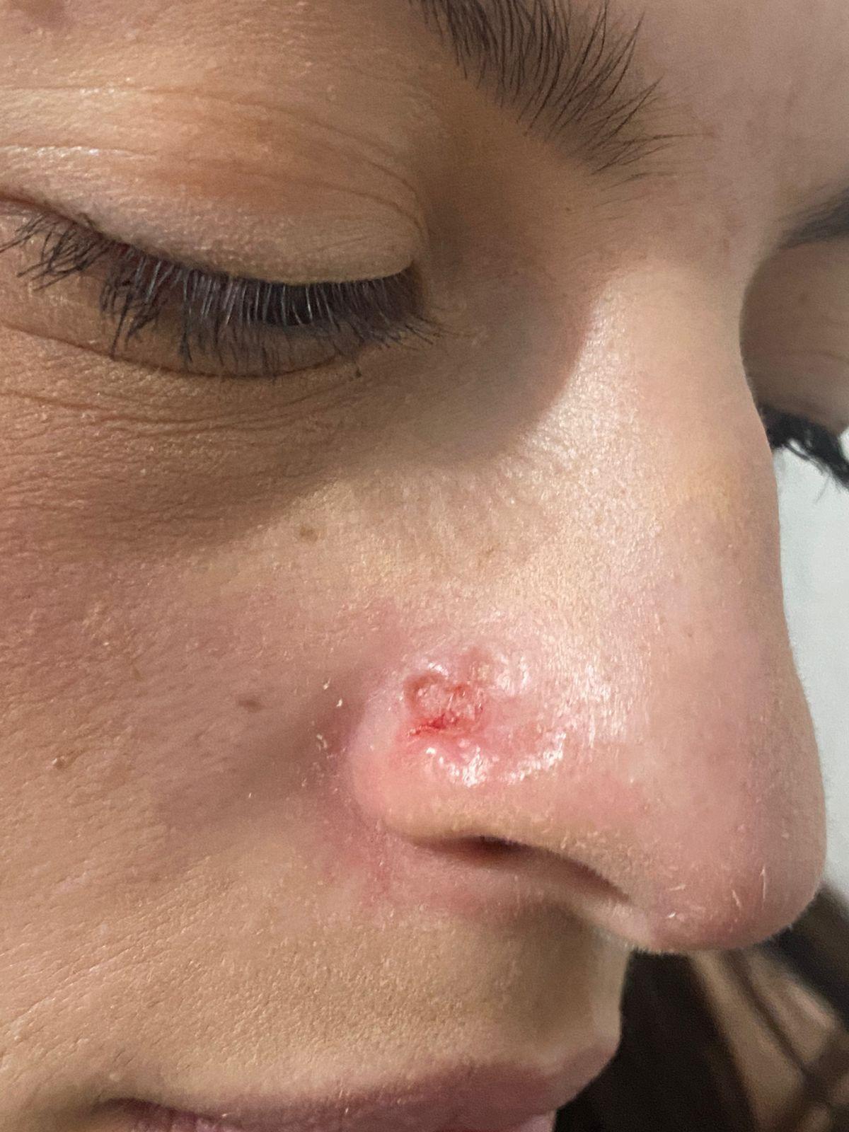 Daiane Lima com ferida no nariz antes do diagnóstico