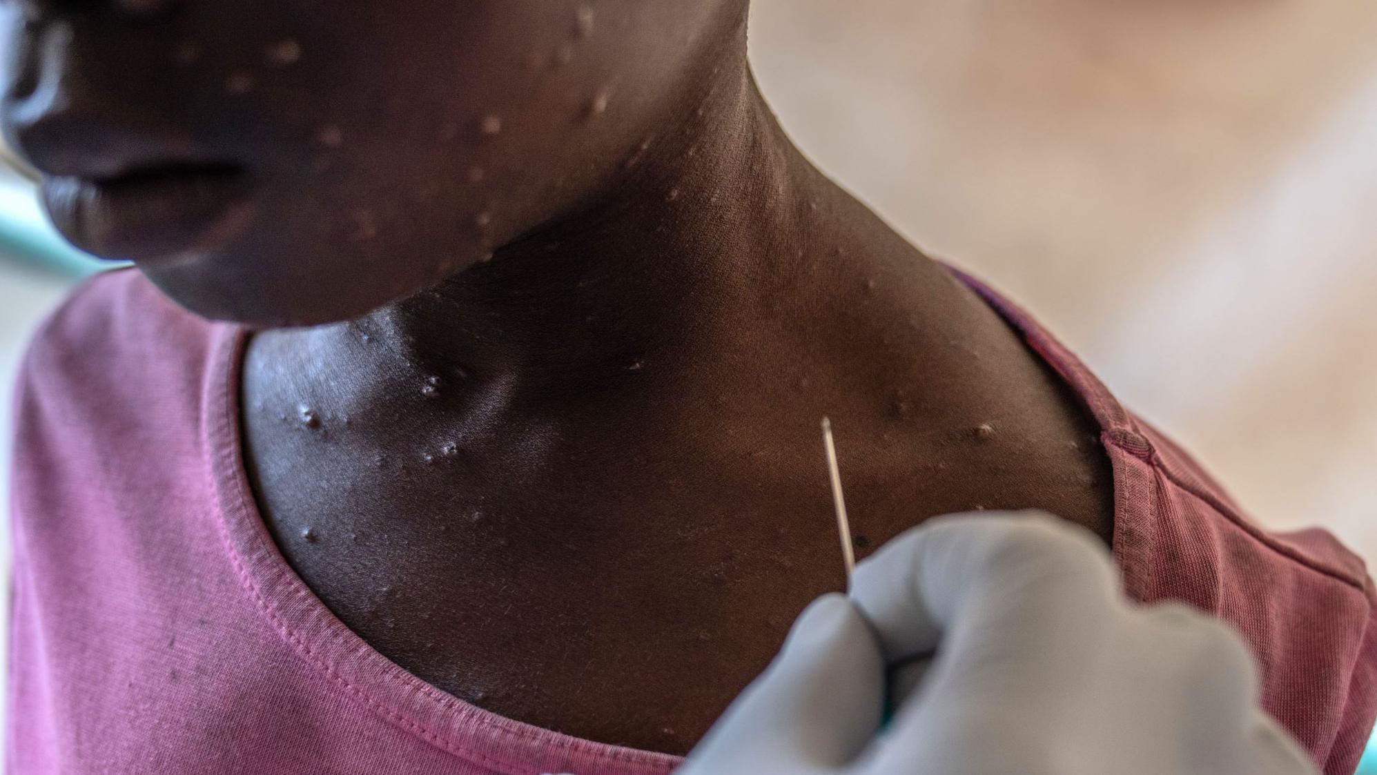 Seorang bocah laki-laki di Munigi, Kongo, mendapatkan perawatan medis untuk mpox yang dideritanya pada 19 Agustus 2024.