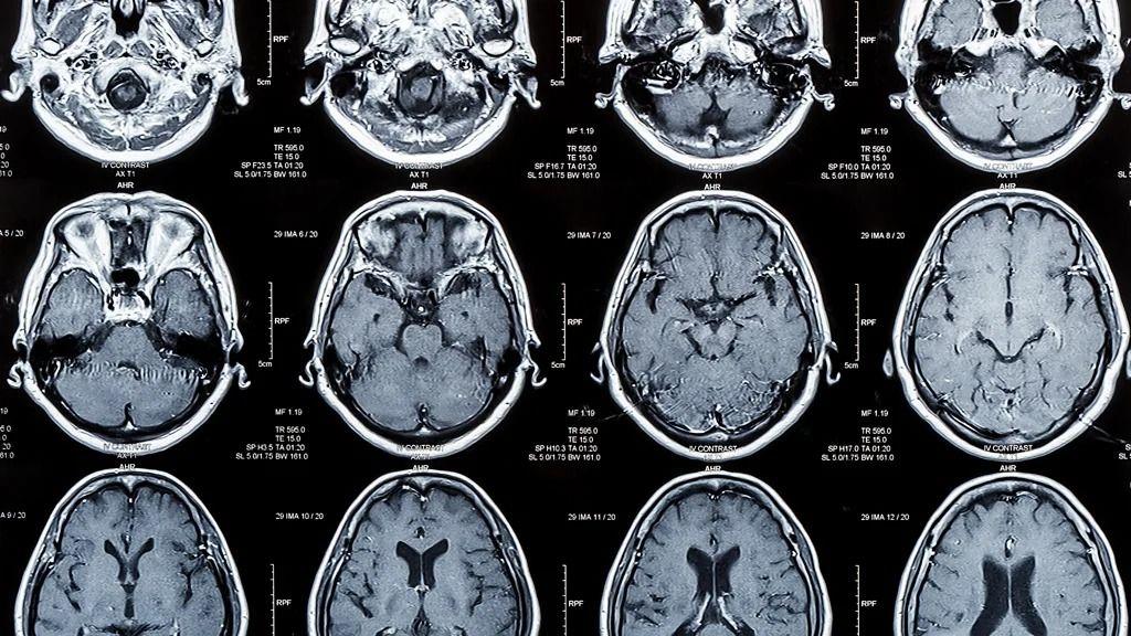 أشعة مقطعية للمخ
