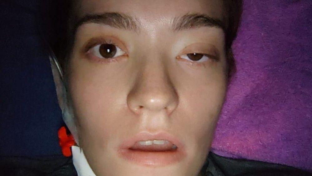 Carolina com metade do rosto paralisado após a última cirurgia